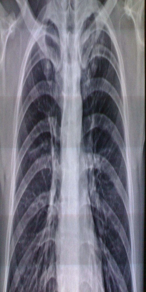 医学影像学呼吸系统复习重点