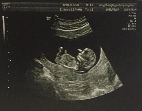 医学影像学——B超