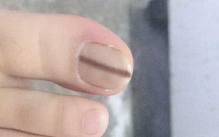 中医学从指甲查病因